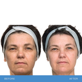 Bio Therapeutic Bt-sculpt