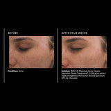 PCA Skin Intensive Clarity Treatment 0.5% pure retinol & salicylic acid